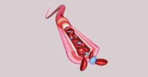 Diagram of an artery and blood vessel with chelation therapy removing toxins.