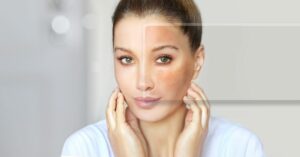 Woman with melasma before and after from glutathione.