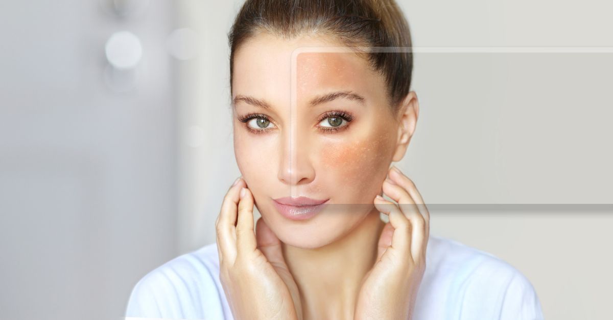 Woman with melasma before and after from glutathione.