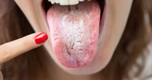 Woman with candida overgrowth showing her white coated tongue--a sign of yeast in the body.